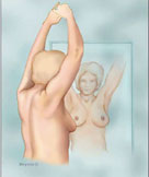 Breast Self-Examination - BBN
