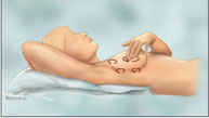 Breast Self-Examination - BBN